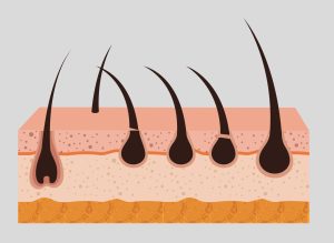 Folliculitis