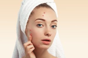 Acne Breakouts